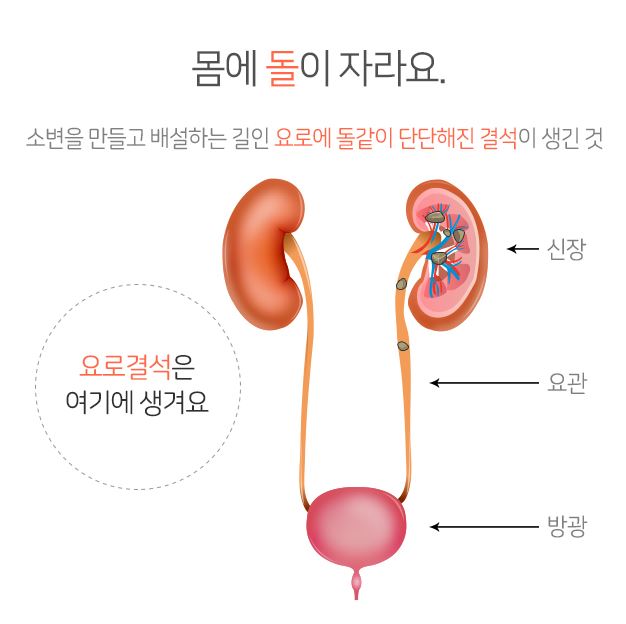 요로결석 증상과 원인, 예방방법은? 요로결석 증상과 원인, 예방방법은?