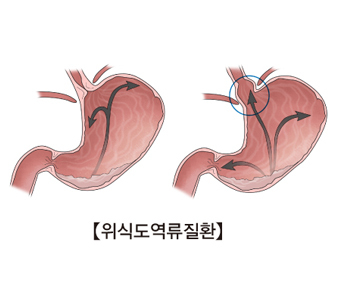 역류성식도염 증상 및 치료