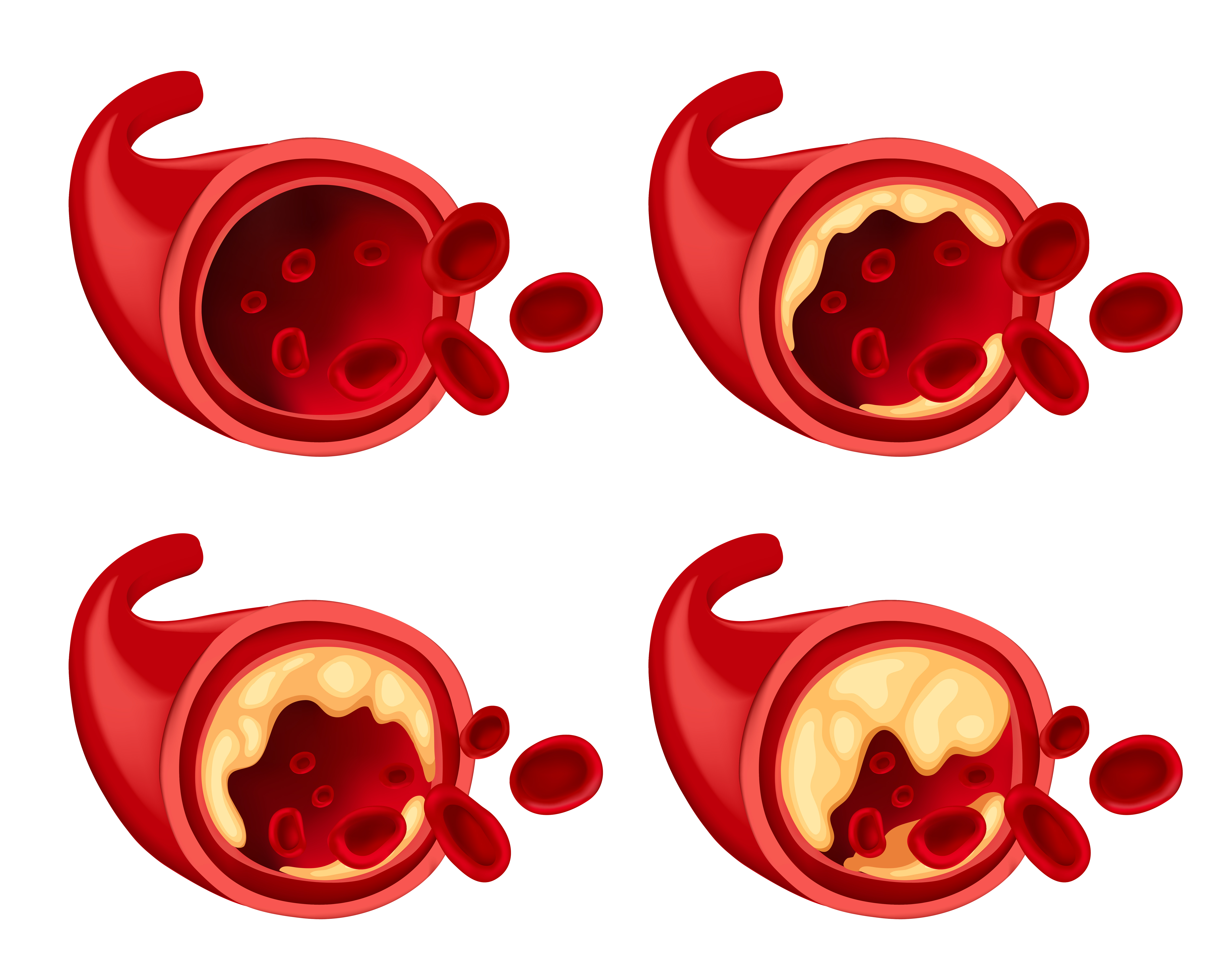 혈관의 단면의 이미지인데, 왼쪽 위부터 정상적인 혈관이고, 오른쪽 위는 고지혈증이 약간 진행된 상태, 왼쪽 아래는 더 많이 진행된 상태, 오른쪽 밑에는 매우 많이 진행된 상태를 나타낸 이미지