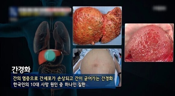  간경화 초기증상 및 좋은 음식과 치료 방법 : 말기 증상