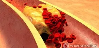총콜레스테롤 이란 정상수치 낮추는법_13