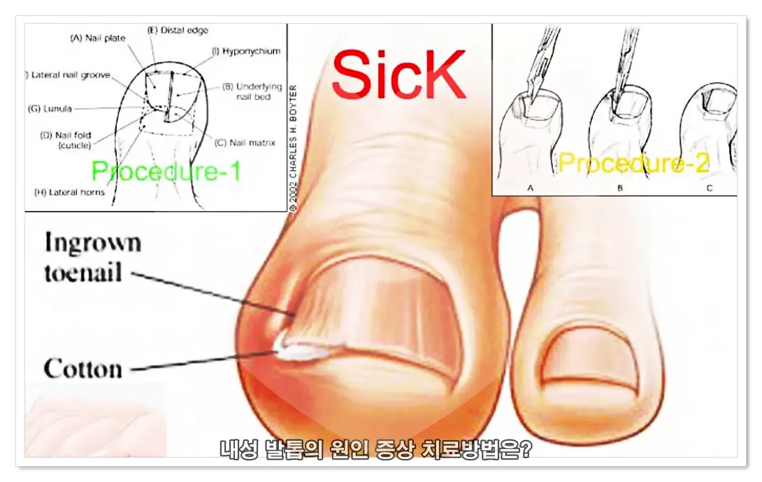 내성 발톱 치료법