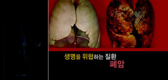 폐암 초기증상