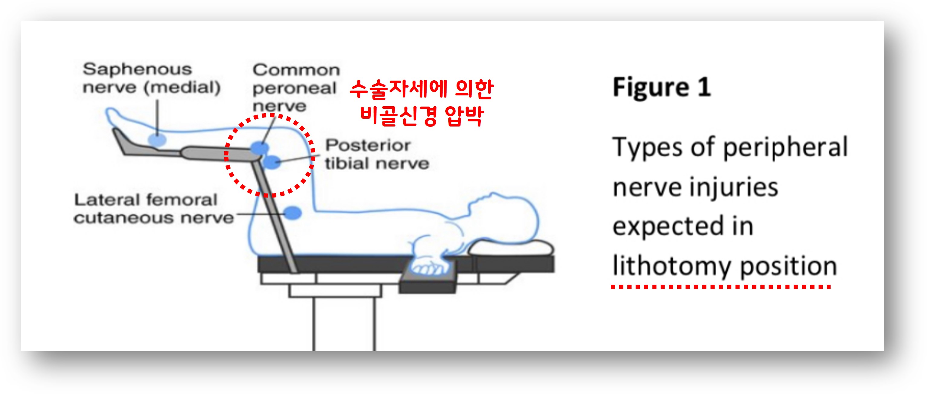 수술이나 장기간 중환자실 치료 후 발목 마비(Post ICU Syndrome, 집중치료 후 증후군)