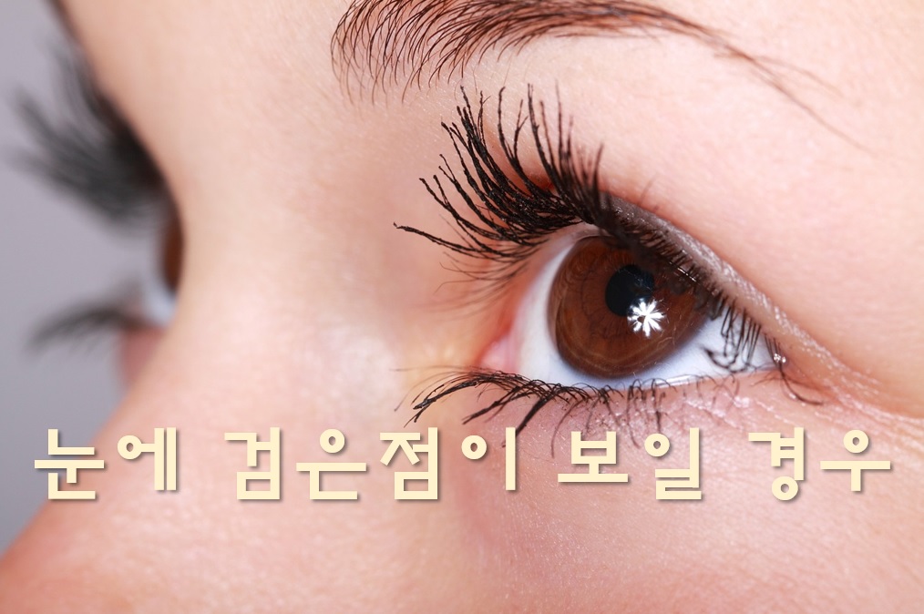  눈에 검은점이 보일 경우와 검은 연기가 보이는 증상