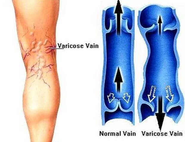 하지정맥류(varicose veins)