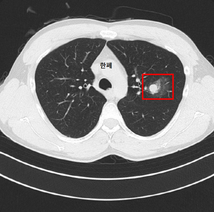 폐결절 폐종양 CT