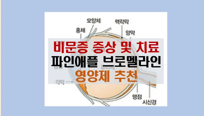 비문증 원인과 증상 치료 방법