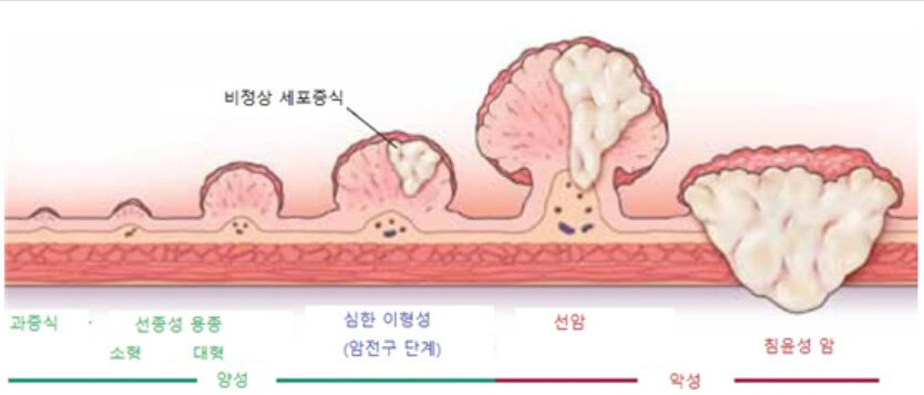 혈액내 포함되어있는 암 특성물질 발견