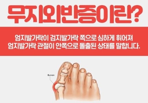 무지외반증