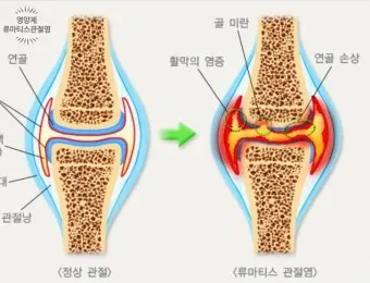 관절염에 좋은 음식 TOP 10_1