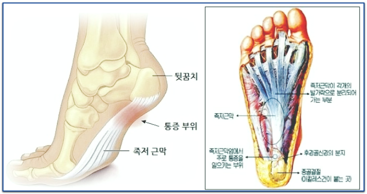 발바닥 통증1