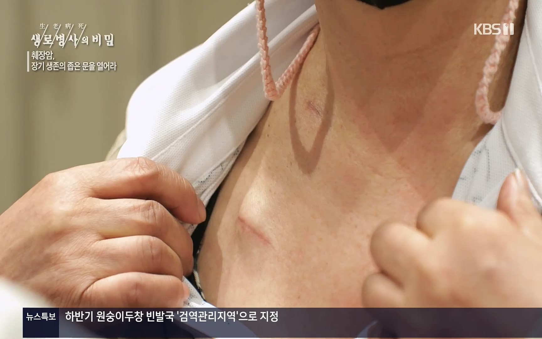 생로병사의 비밀.E823.220622p.H264-F1RST.mp4_20220624_210521.962.jpg