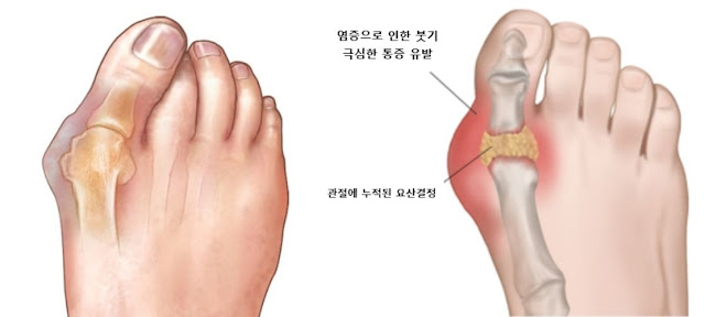 통풍의 원인 그리고 통풍에 안좋은 음식 알아보기