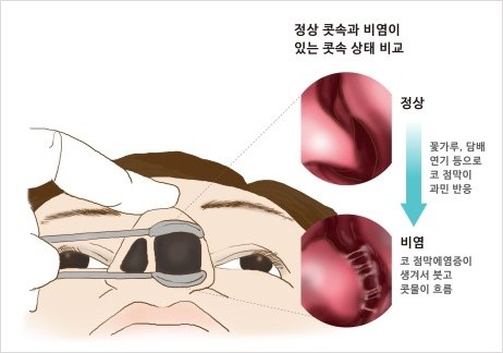 비염을 방치하면 축농증이 되는 가능성이 높아지며&#44; 부비동염과 같은 합병증이 발생할 수 있습니다. 따라서 비염 증상이 나타났을 때 적절한 치료와 예방 조치를 취하는 것이 중요합니다. 건강한 생활 습관과 환경 관리를 통해 비염과 부비동염을 예방하고&#44; 증상이 나타날 경우 의료 전문가의 도움을 받는 것이 필요합니다.