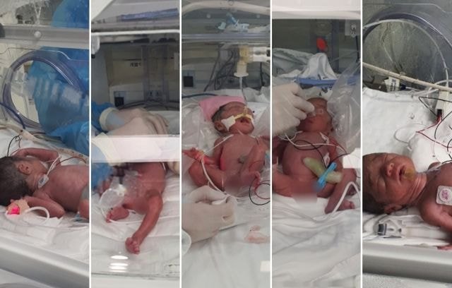  다섯쌍둥이 한국서 34년 만에 건강하게 태어남