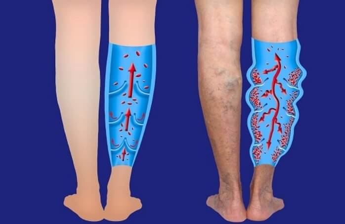 하지정맥류의 원인을 알아보면?