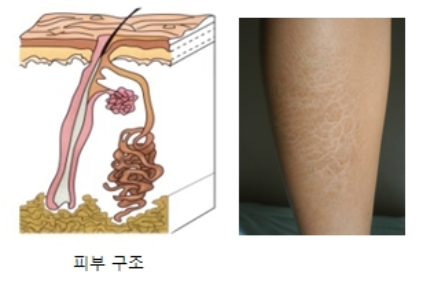  피부건조증 증상과 치료법