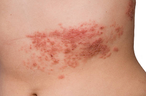 Understanding Symptoms and Prevention of Shingles That Suddenly Appears with Accumulated Fatigue.
