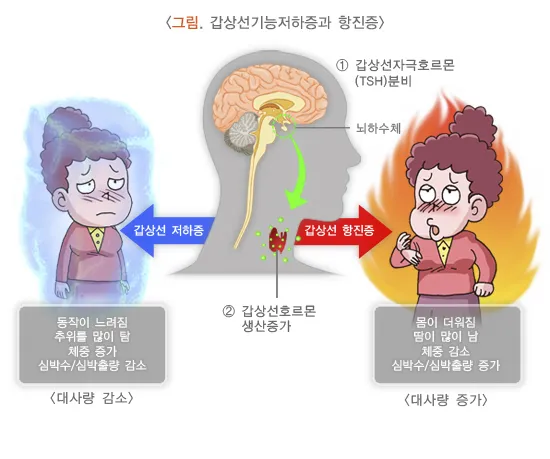갑상샘 저하증 갑상선 기능저하증 증상 수치 치료_1