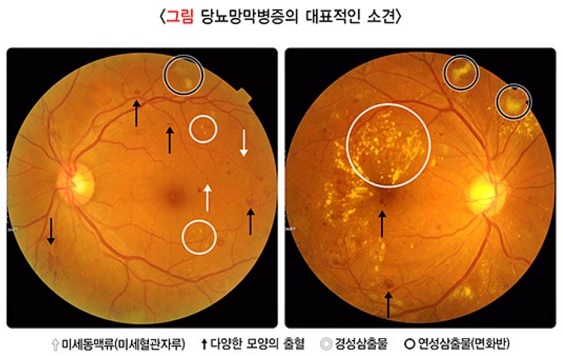 당뇨망막병증