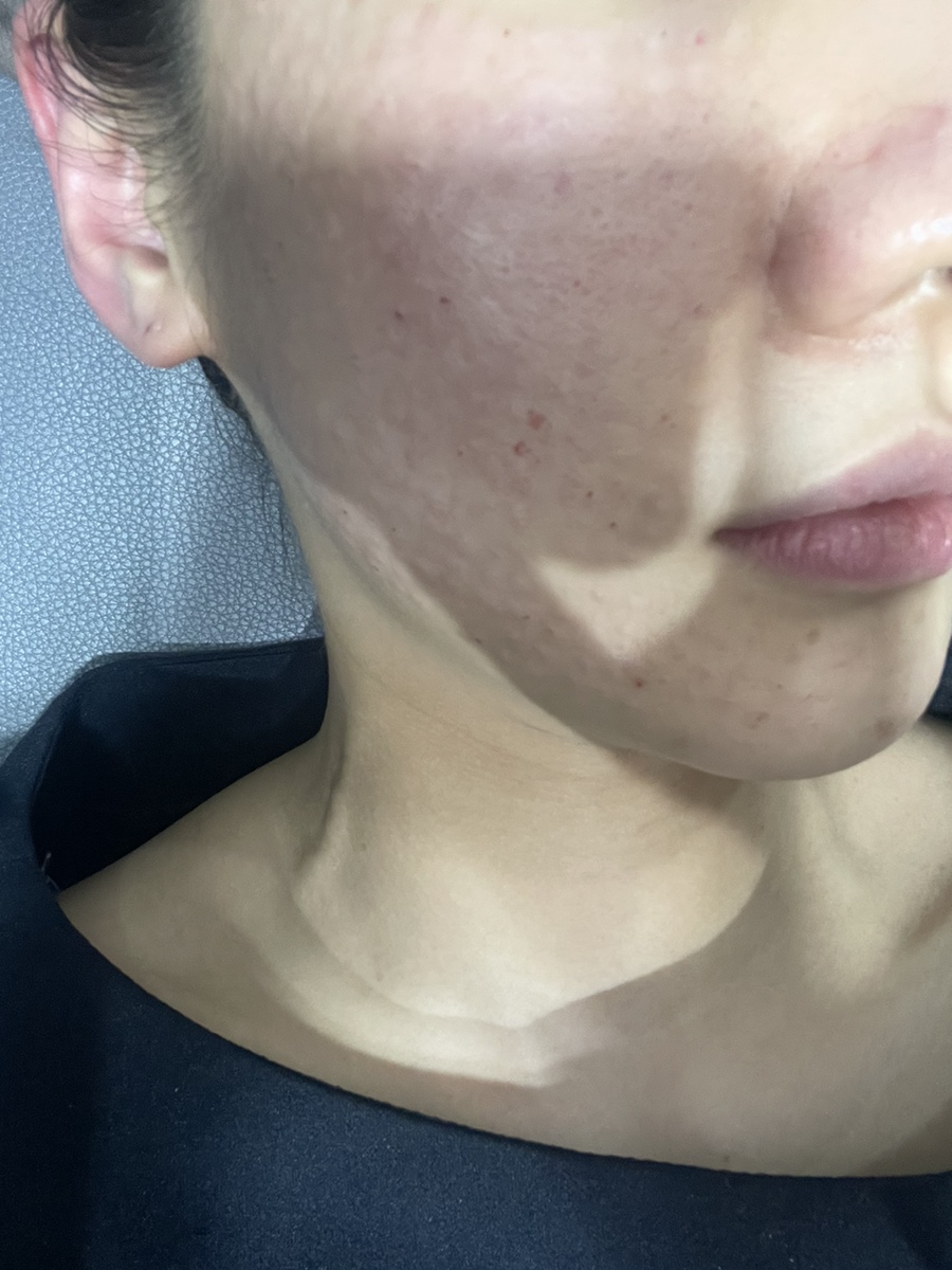 코조각주사 콧볼축소 효과 12