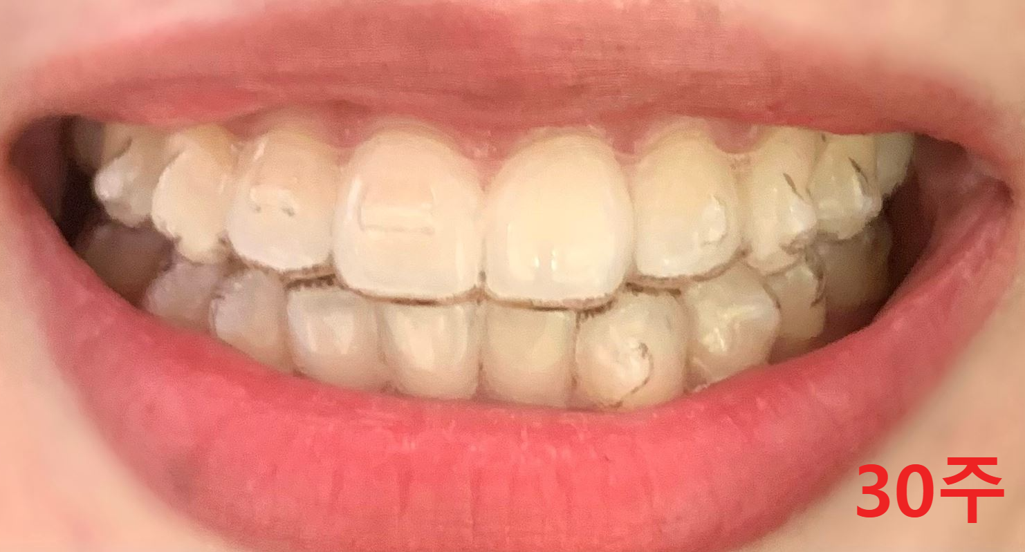 인비절라인-착용-30주-사진