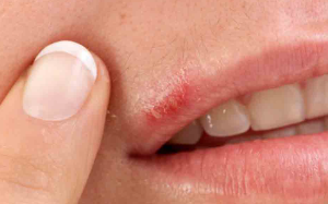 Understanding and Treating Herpetic Stomatitis&#44; the Blisters Around the Lips Caused by Fatigue.