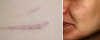 흉터전용 치료 추천 스카덤 겔 효능효과_33