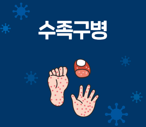 수족구병 예방과 치료 여름철 아이 건강 관리