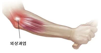 테니스엘보