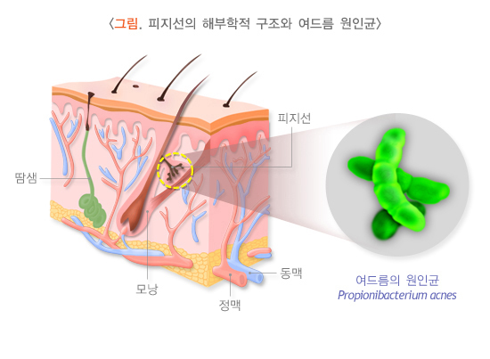  여드름