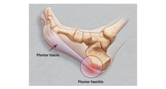 족저근막염 해부학 사진 