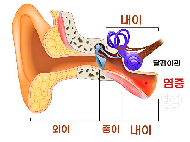 어지럼증 원인 귓병 어지러움 원인 내이염 중이염