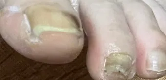 라셀턴 사용법과 가격 비교 발톱앰플 후기 정리해보기_7