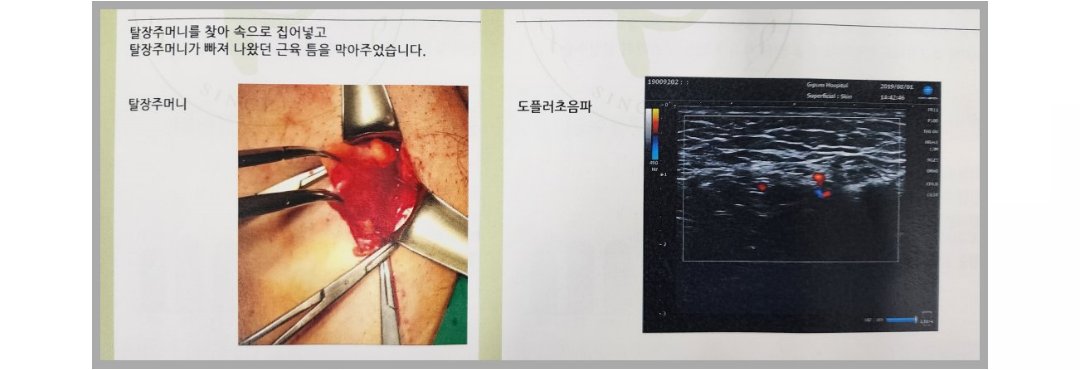 실제-탈장수술-초음파 사진