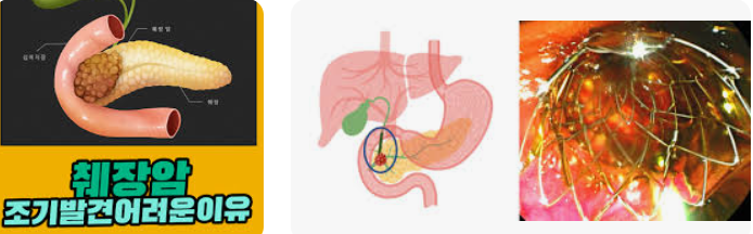췌장암 초기 발견이 어려운 이유