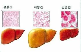 지방간 없애는 방법