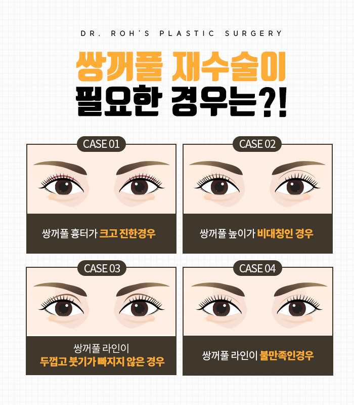 합리적인 쌍꺼풀 재수술 비용 쌍꺼풀 부분절개