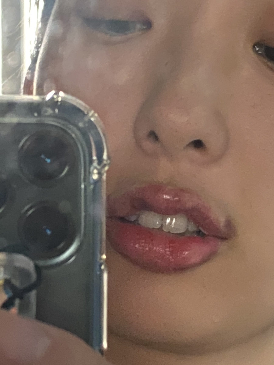 입술 보톡스 부작용 대전 입술필러+입꼬리보톡스 내돈내산 9