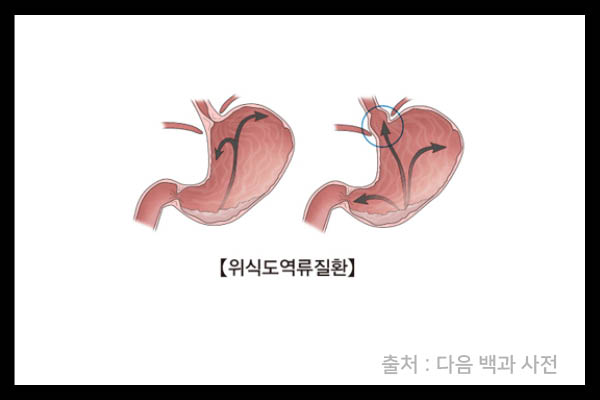 가슴 답답한 소화불량, 스트레스로 인해 숨쉬기 불편하고 무기력 우울 (원인은 자율신경;수지 판교 분당 한약치료 배재욱 한의원) 4
