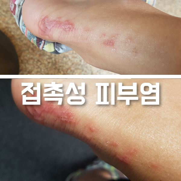 프레드린로션) 영유아(13개월) 피부질환 습진, 가려움증 발진, 아토피, 지루성 피부염 연고제 권장
