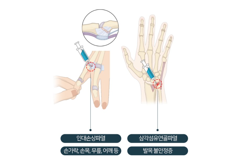 [프로필 치료/프로필러 주사] 프롤린 주사 부작용은? 16