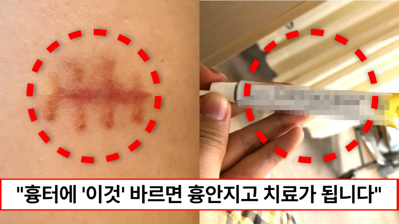 "흉터가 감쪽같이 사라집니다" 피부과 전문의가 알려주는 상처와 흉터에 알맞은 연고 선택 방법