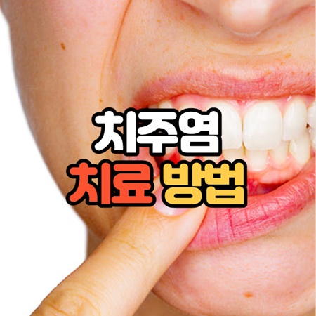 치주염 치료 방법