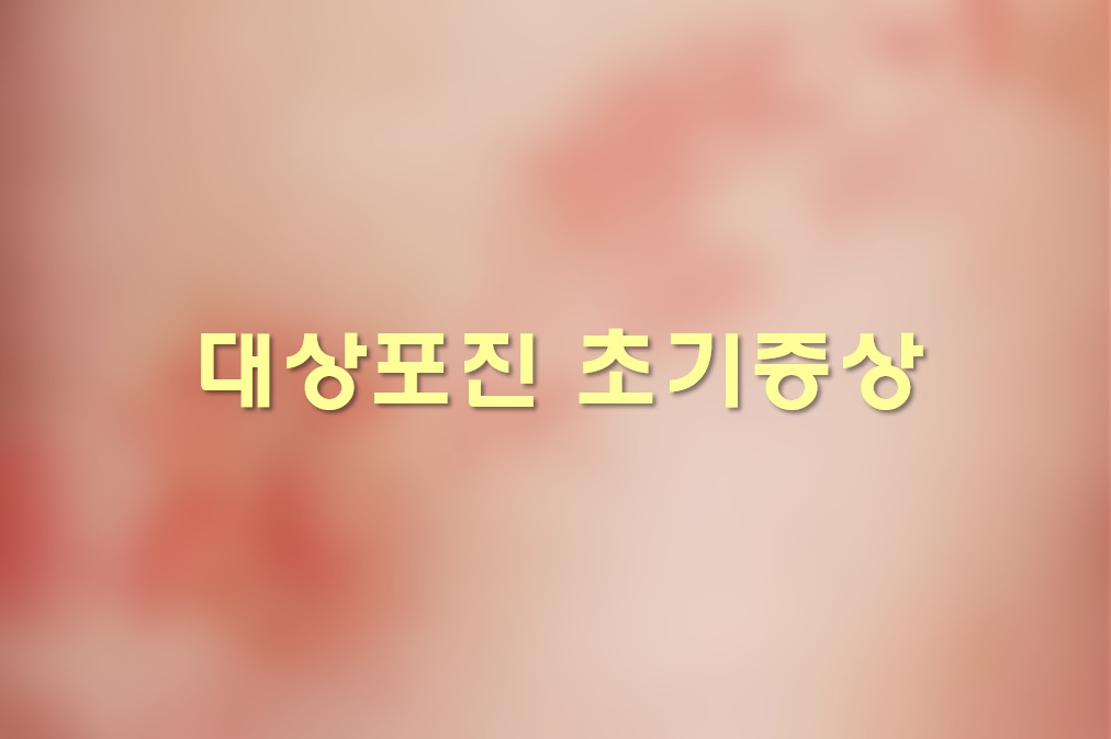  대상포진 초기증상과 대상포진 치료방법