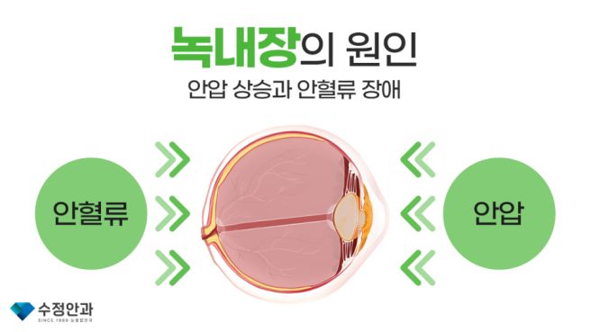 녹내장 증상