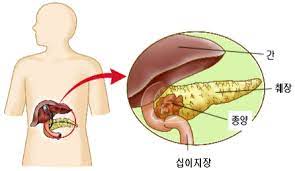 췌장암 의심 증상 여섯가지 발생원인 초기 의심 증상 검사방법 예방법