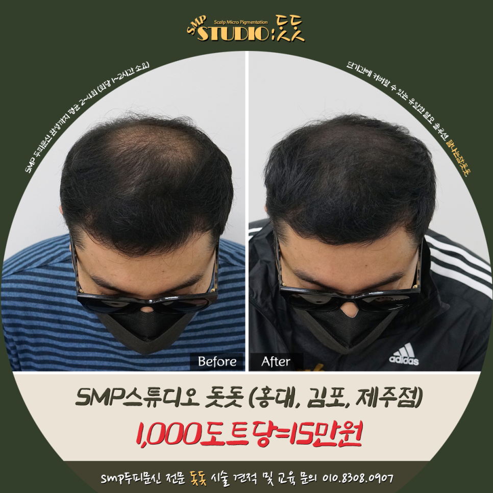  탈모 머리 두피문신 비용과 머리숱 보강 결과