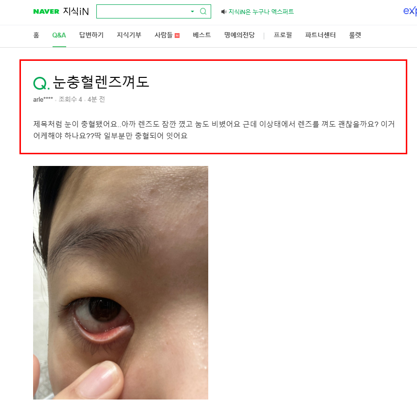 눈 충혈 렌즈 착용 질문